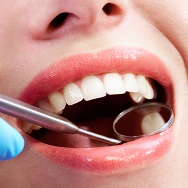 Dentist examining a tooth colored filling