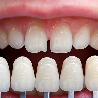 Chipped teeth compared to a series of veneers.