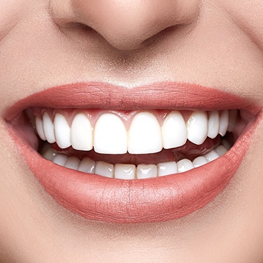 Closeup of smile after cosmetic gum recontouring