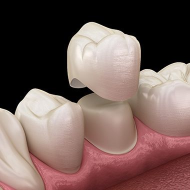 a computer model of a dental crown in Avon being placed on a tooth