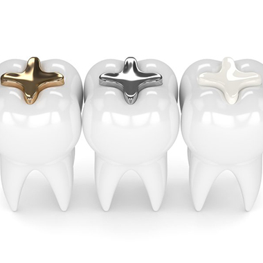 models of teeth with gold, silver, and tooth-colored fillings 