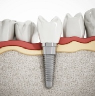 Animated dental implant supported dental crown