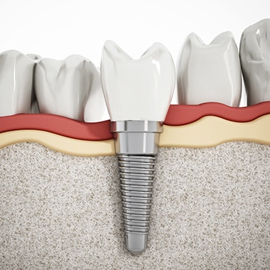 Animated dental implant supported dental crown