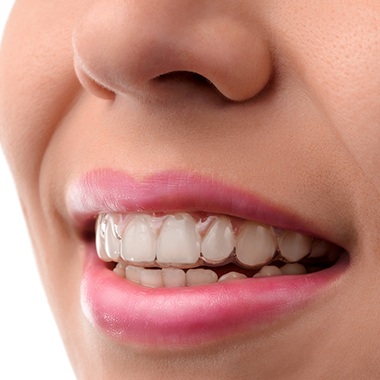 Closeup of patient with Invisalign tray in place